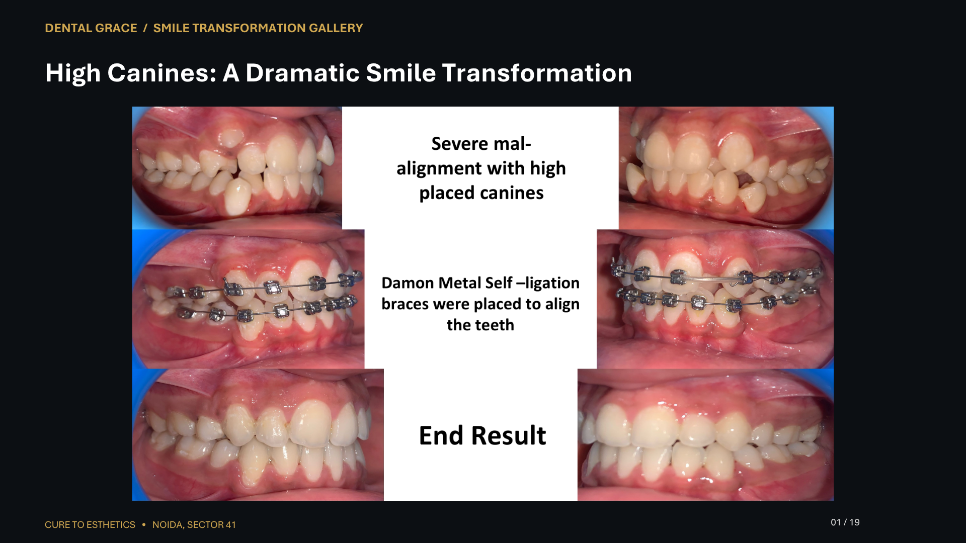 Dental Grace patient result 1 – before and after smile transformation