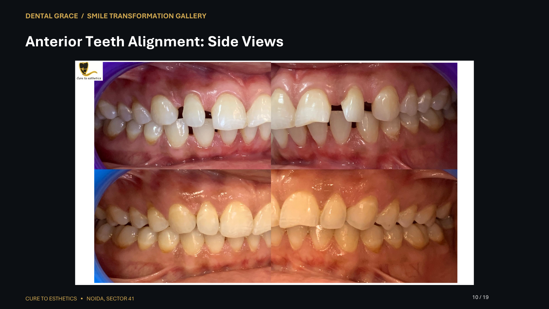 Dental Grace patient result 10 – before and after smile transformation