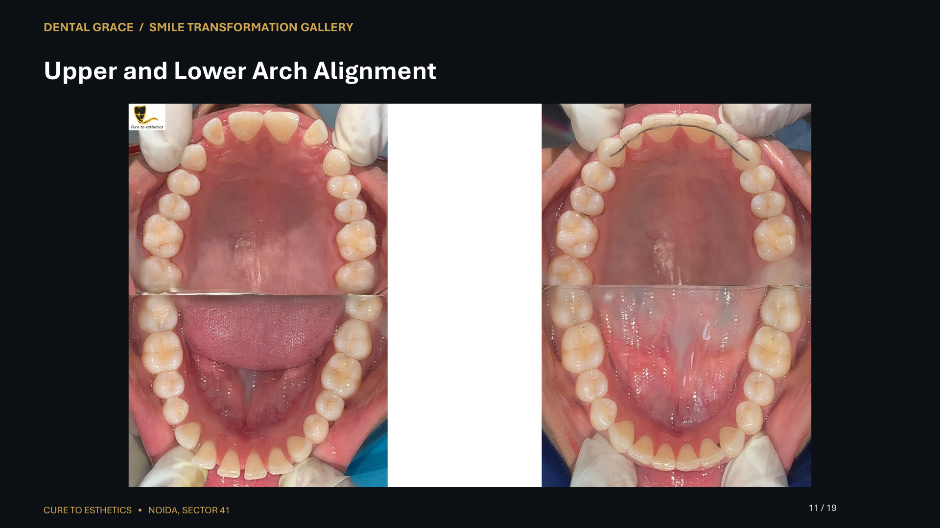 Dental Grace patient result 11 – before and after smile transformation