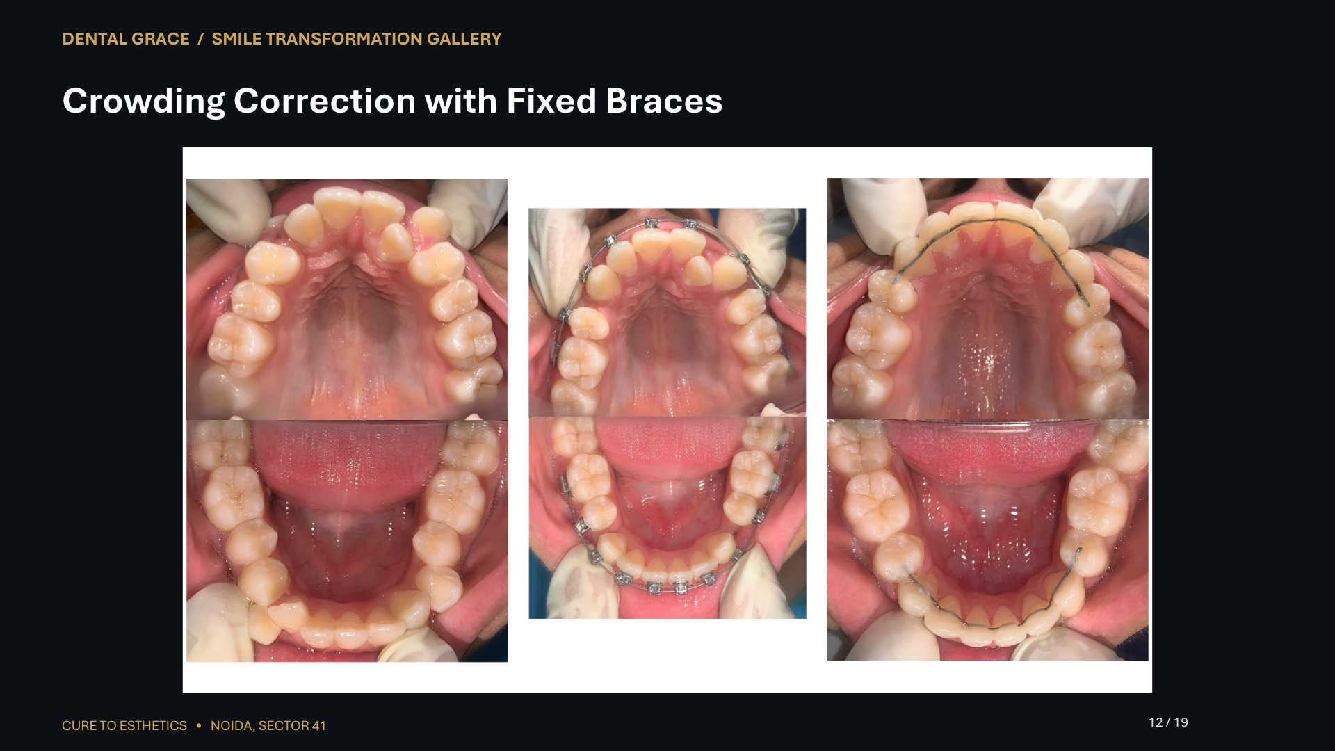 Dental Grace patient result 12 – before and after smile transformation