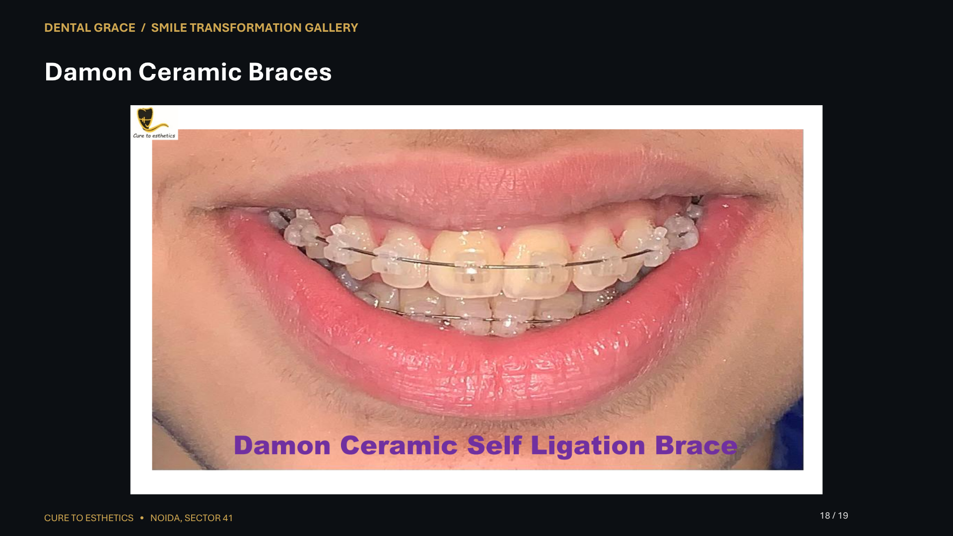 Dental Grace patient result 18 – before and after smile transformation