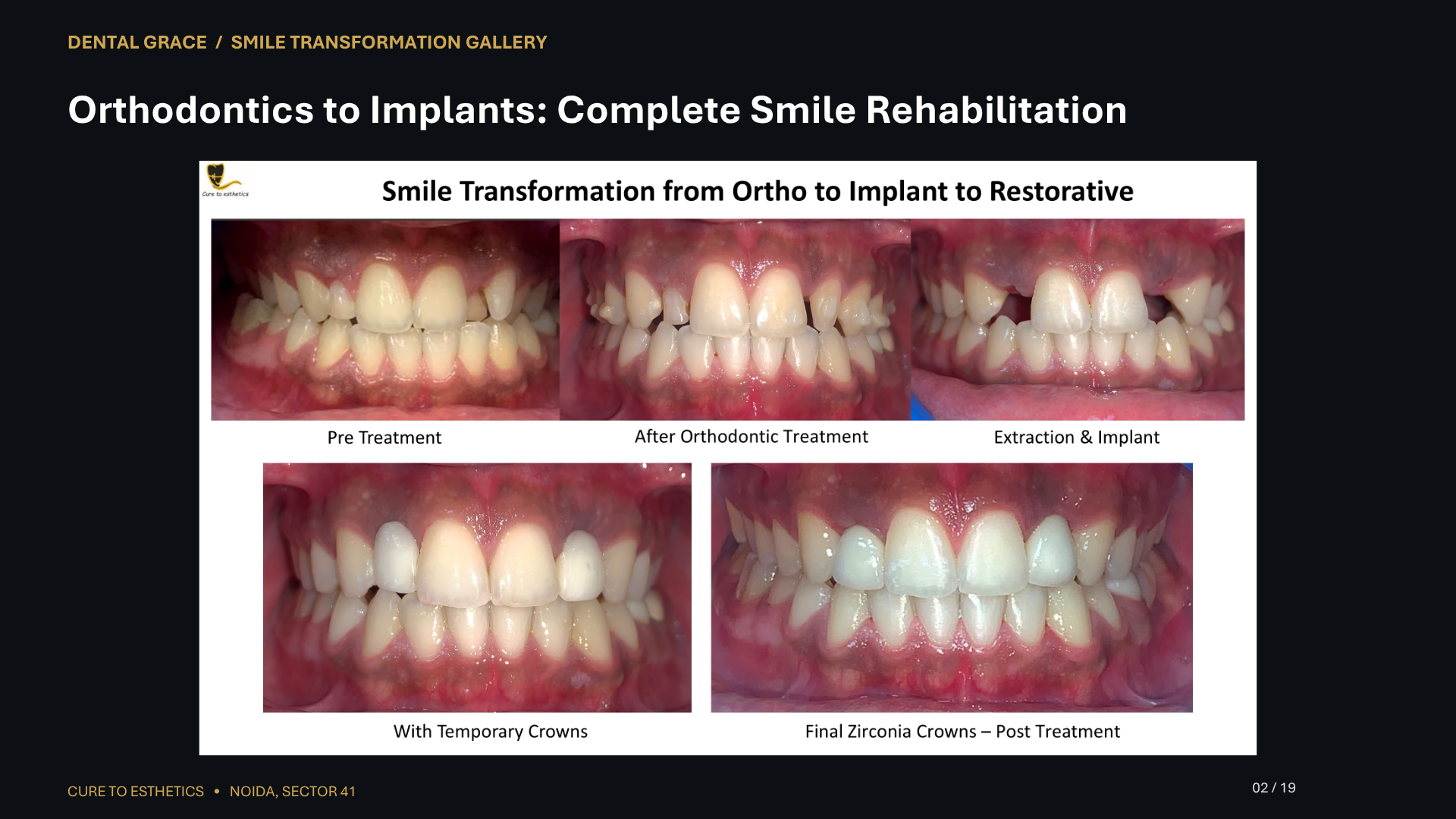 Dental Grace patient result 2 – before and after smile transformation