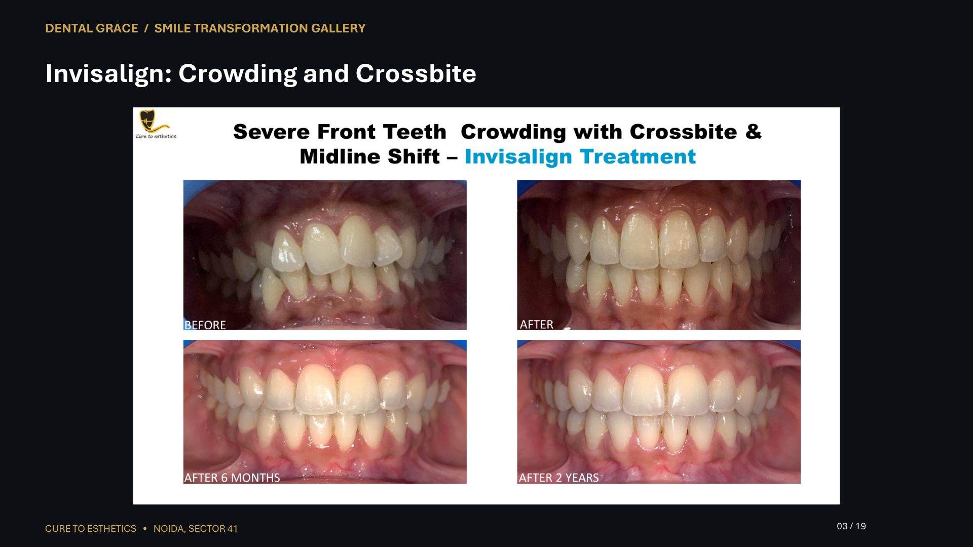 Dental Grace patient result 3 – before and after smile transformation