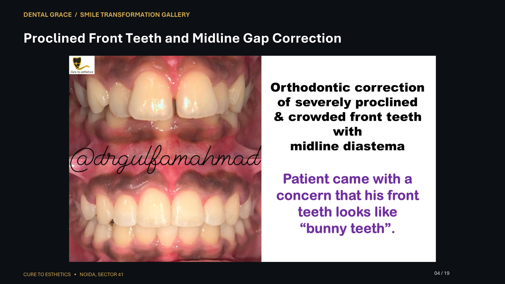 Dental Grace patient result 4 – before and after smile transformation