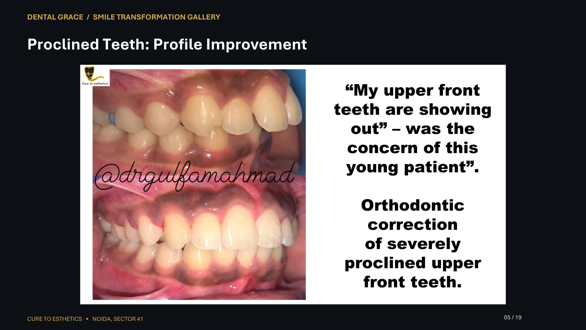 Dental Grace patient result 5 – before and after smile transformation