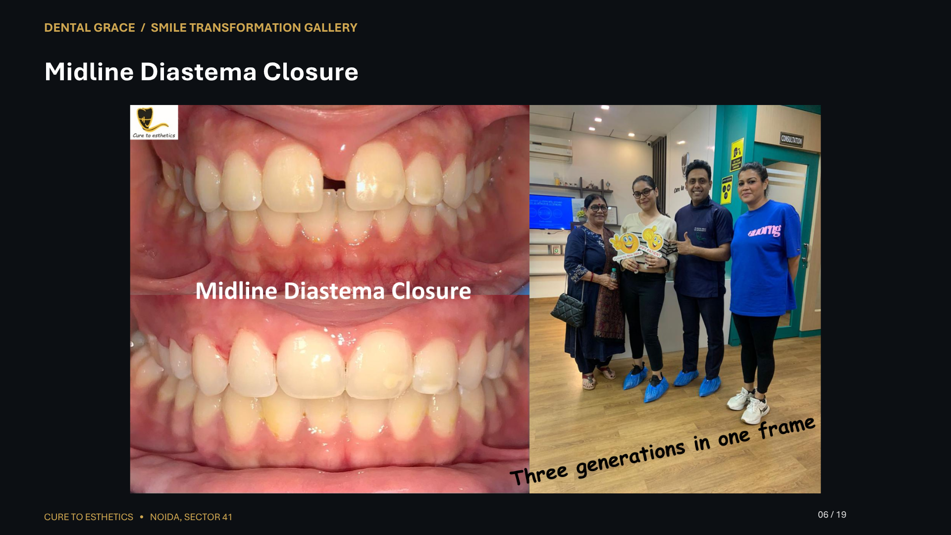 Dental Grace patient result 6 – before and after smile transformation