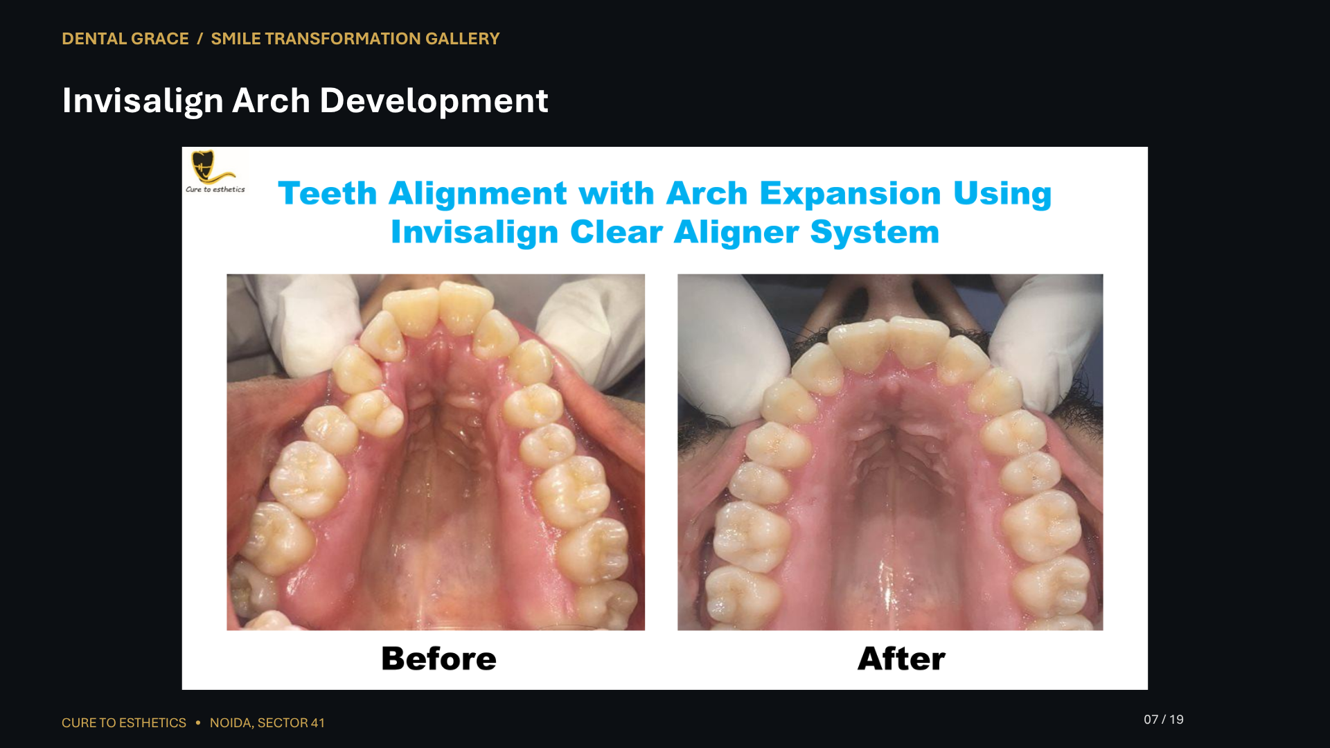 Dental Grace patient result 7 – before and after smile transformation