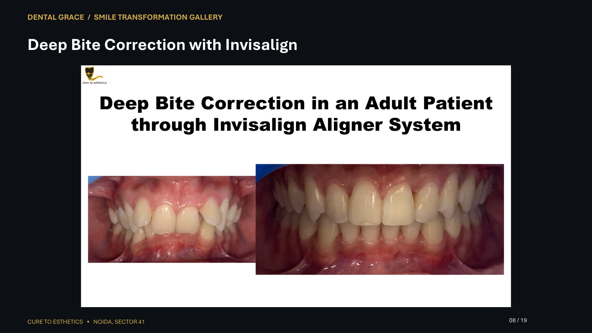 Dental Grace patient result 8 – before and after smile transformation