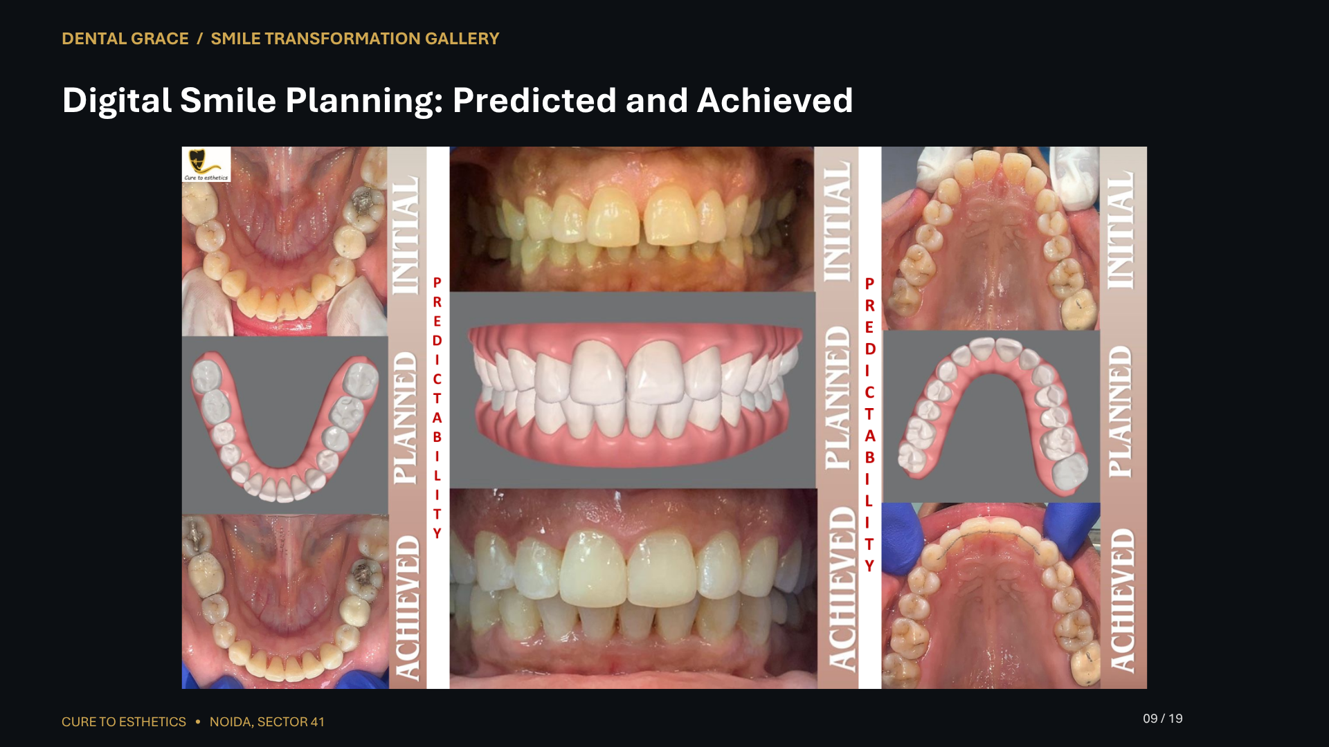 Dental Grace patient result 9 – before and after smile transformation